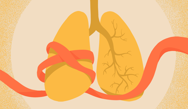 COPD